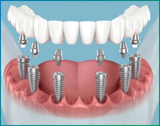 Dental Implant